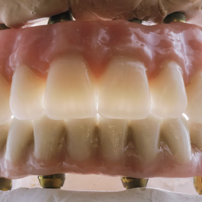 All-on-4 Brücke auf Oberkiefer-Modell, Draufsicht aller Zähne