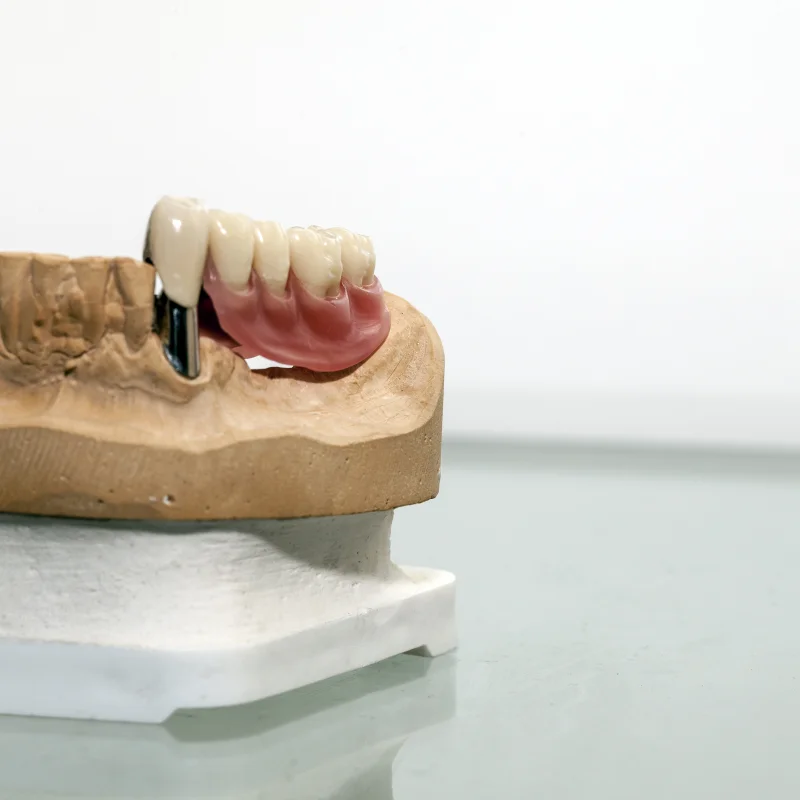 Unterkiefer-Teilprothese mit Teleskopkronen, präzise Passung