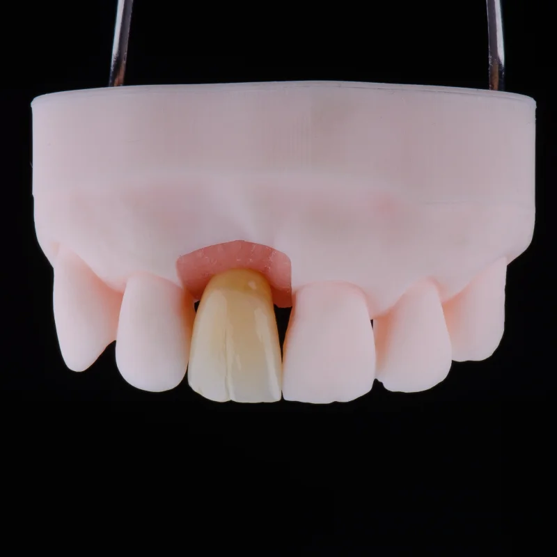 Vollkeramik-Krone Frontzahn Zahn 11 mit natürlicher Transluzenz