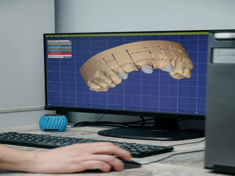 CAD-Bildschirm mit 3D-Zahnmodell, Fräsmaschine im Hintergrund
