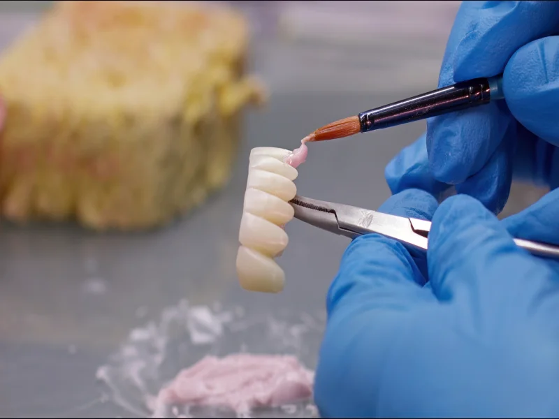 Mehrere Vollkeramik-Kronen auf Glasträger – Festsitzender Zahnersatz