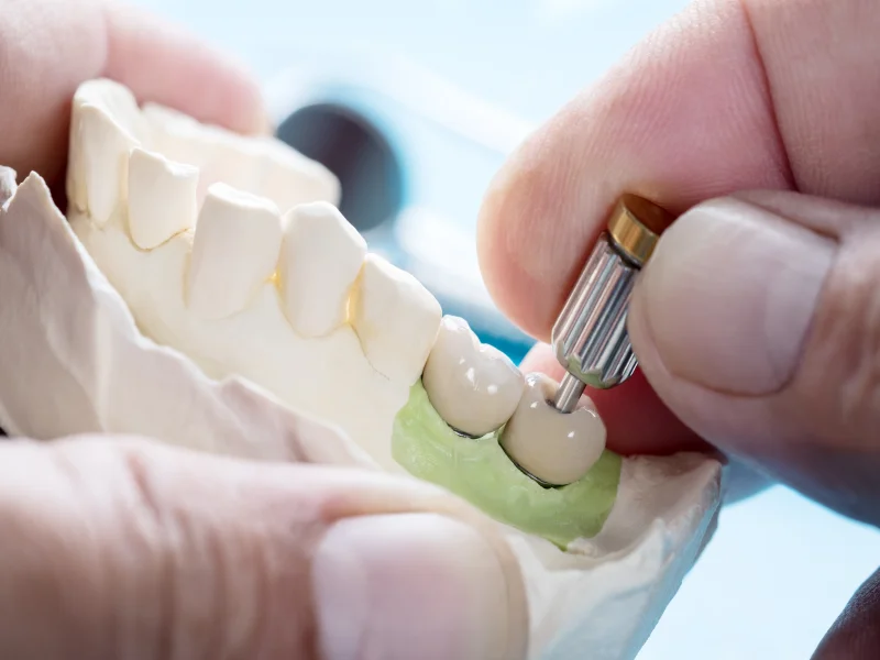Implantat-Komponenten: Schraube, Abutment und Krone